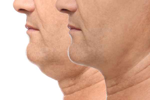 HIFU - Breakthrough in Anti - ageing 2 hifu results Peterborough