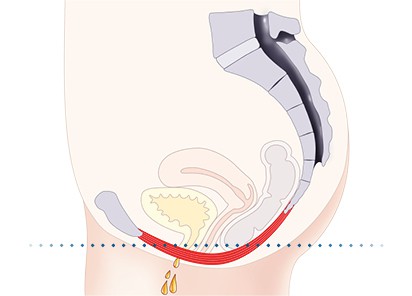 Pelvic-Floor Muscle Repair 5 Pelvic floor muscles Peterborough