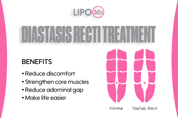 Revolutionising Muscle Repair: The Power of LIPO360 Body Sculpt Post-Injury 5 diastasis recti treatment Peterborough