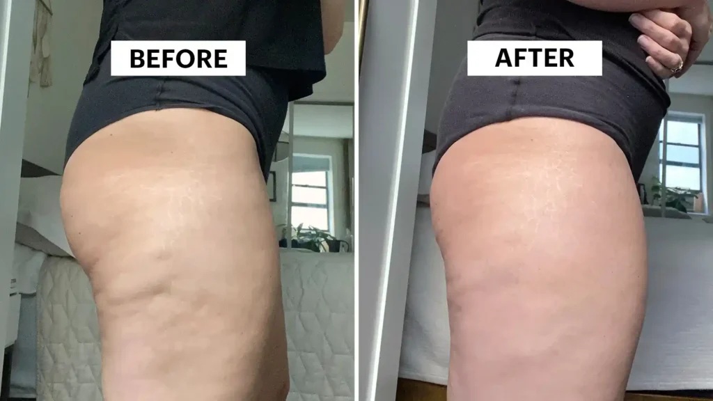 Sculpting Your Bum: Can Toning Exercises Really Reduce Cellulite? 1 Do Toning Exercise Peterborough Really Tackle Cellulite?