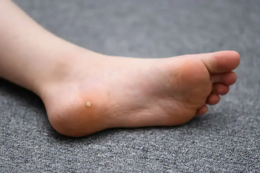 Cryotherapy For Warts And Also Verrucas 2 Image of verruca on the bottom of the foot that able to be treated with Cryotherapy Peterborough