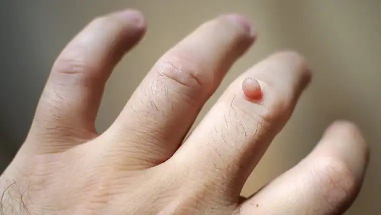 Cryotherapy For Warts And Also Verrucas 1 Image of blemish that Cryotherapy Peterborough can remove with Lipo 360.