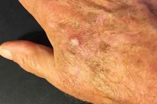 Image of Actinic keratoses Peterborough on a person hand