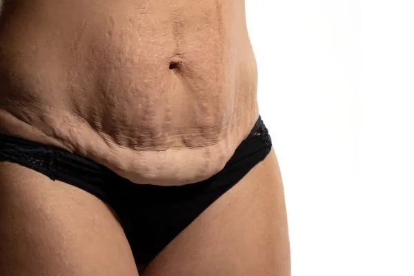The Science of Skin Tightening 1 The science behind skin tightening Peterborough picture of a woman's sagging skin on the stomach
